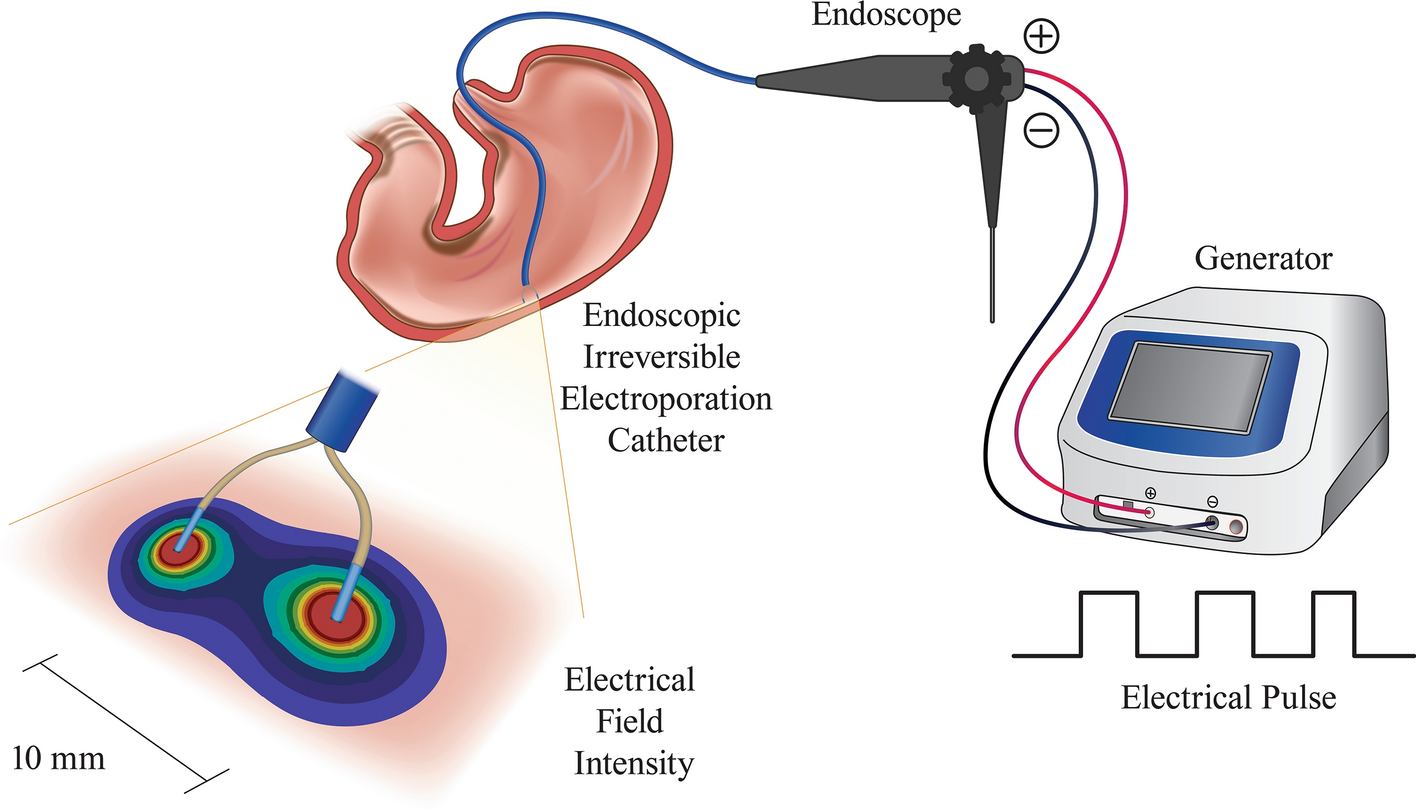 Feasibility and effectiveness of endoscopic irreversible electroporation  for the upper gastrointestinal tract: an experimental animal study |  Scientific Reports