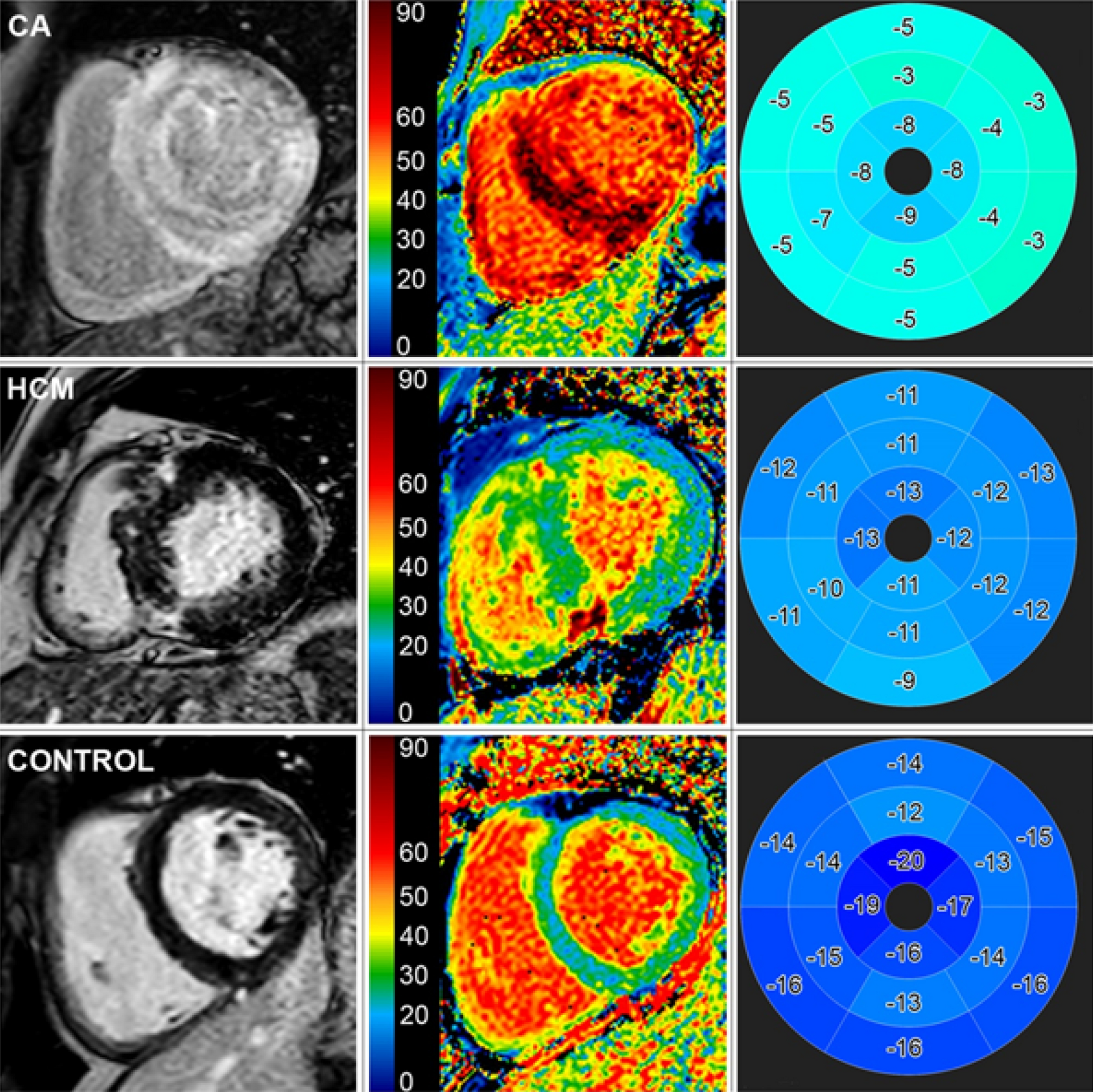 Diagnostic and prognostic value of cardiac imaging in amyloidosis