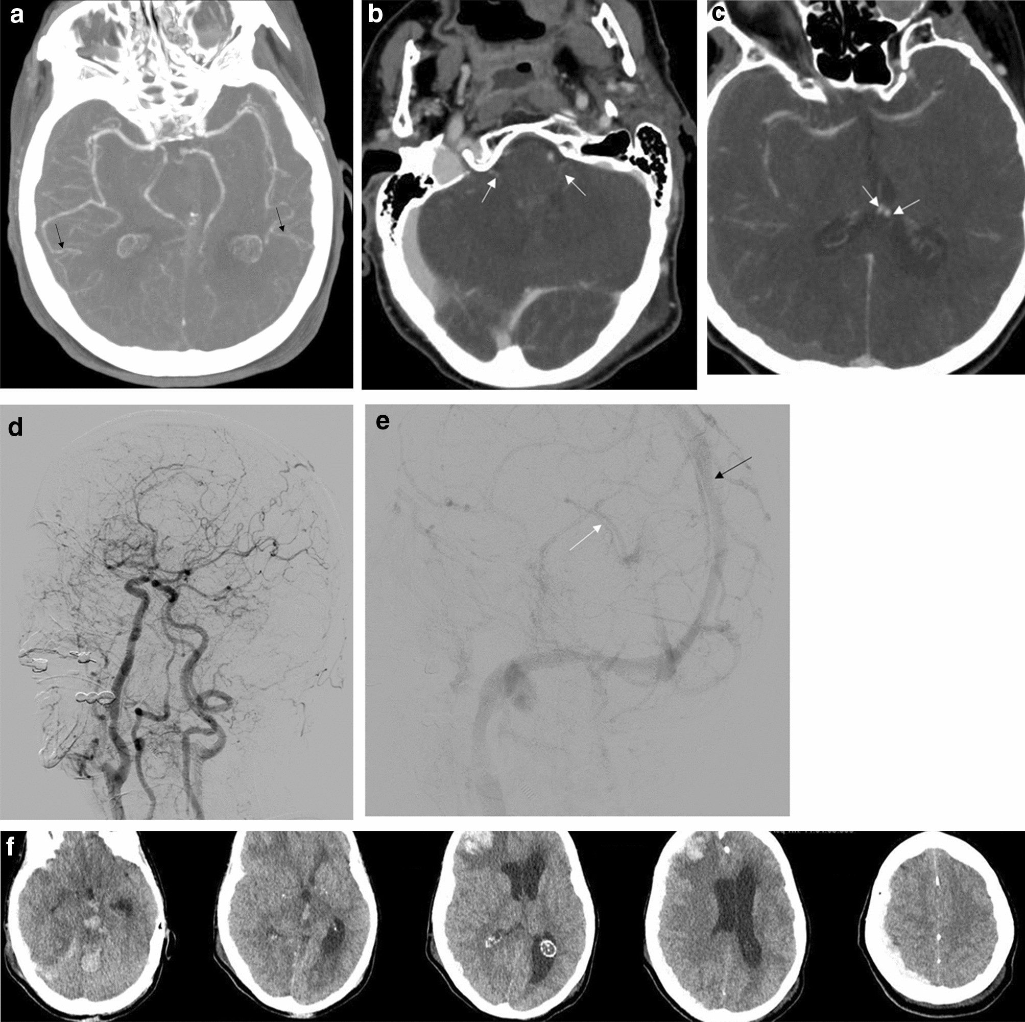 Computed tomography angiography scoring systems and the role of defects in the of brain death Scientific Reports