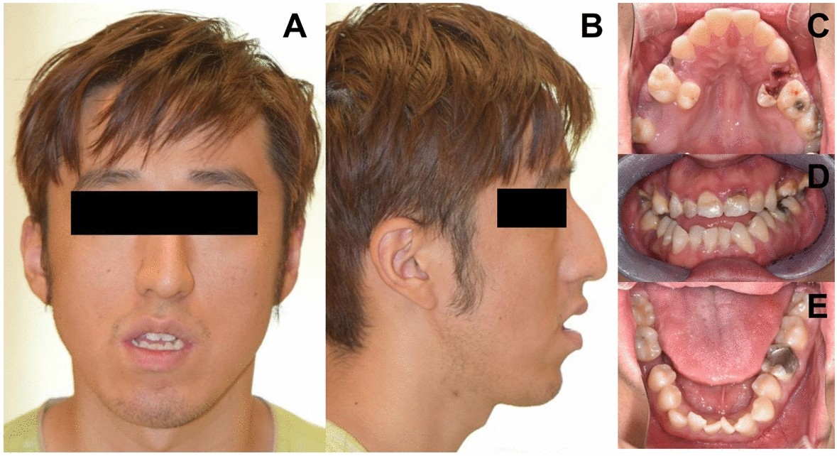 Identification of de novo EP300 and PLAU variants in a patient with  Rubinstein–Taybi syndrome-related arterial vasculopathy and skeletal  anomaly