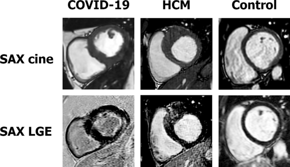 Modtager maskine Souvenir Sportsmand A cardiovascular magnetic resonance imaging-based pilot study to assess  coronary microvascular disease in COVID-19 patients | Scientific Reports