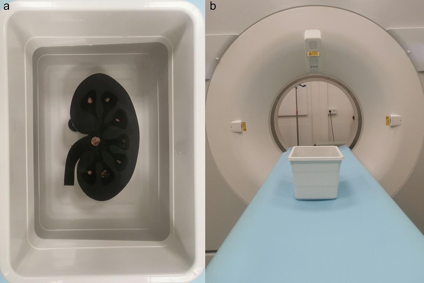 Manual kidney stone size measurements in computed tomography are most  accurate using multiplanar image reformatations and bone window settings |  Scientific Reports