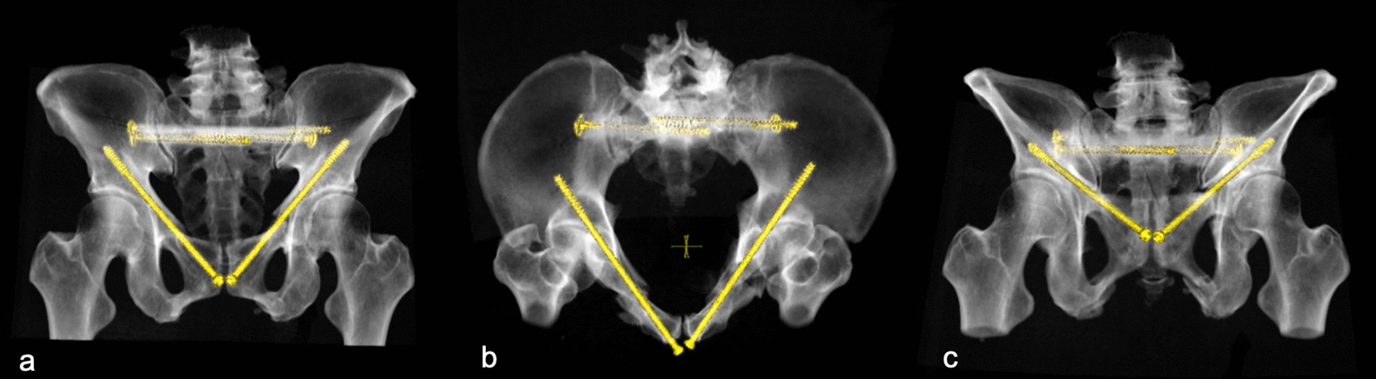 Fragility fractures of the pelvis: An update - Journal of Musculoskeletal  Surgery and Research