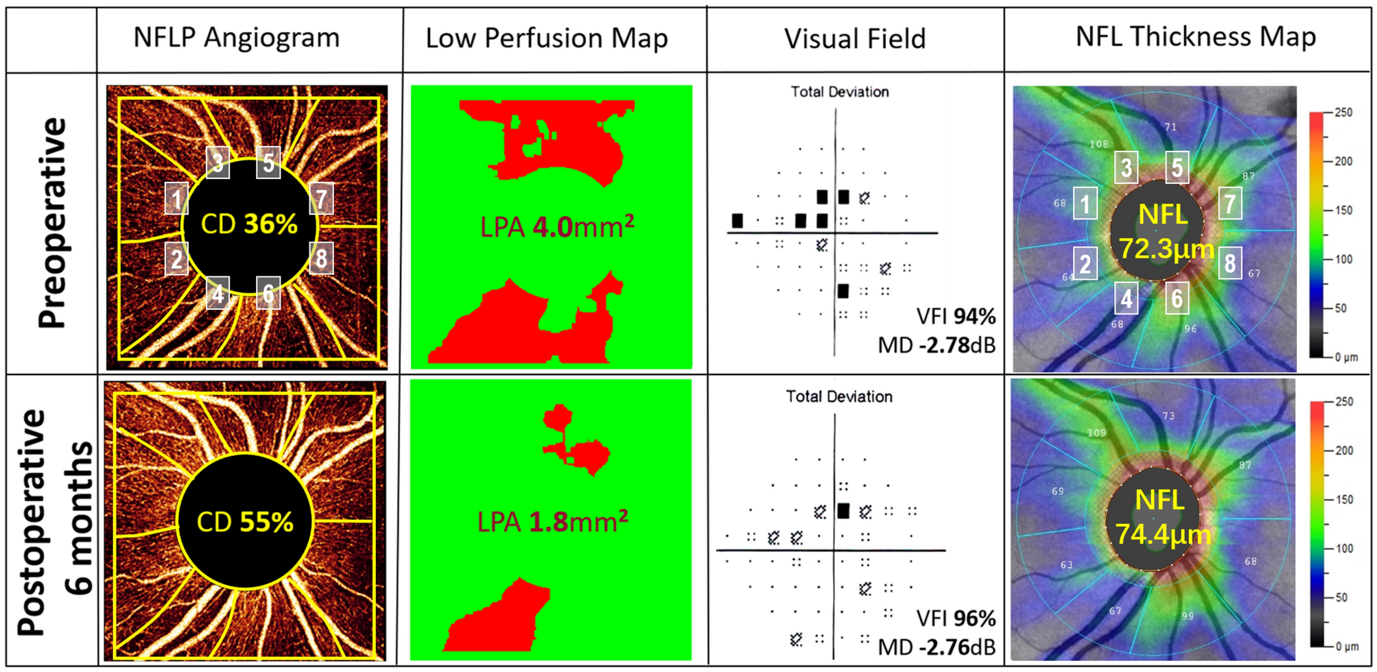 Optical coherence tomographic angiography study of perfusion recovery after  surgical lowering of intraocular pressure | Scientific Reports
