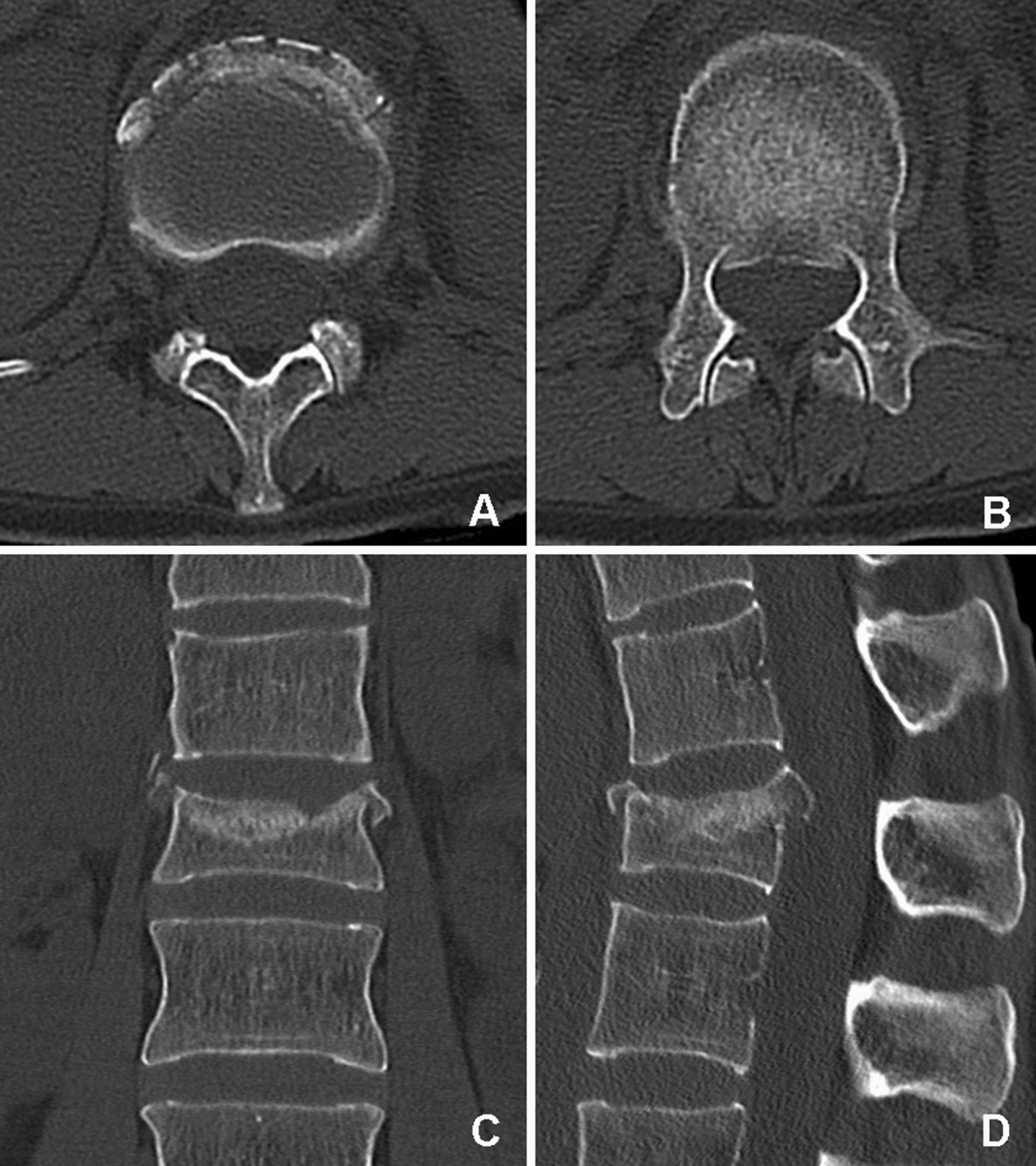 Comparing porous tantalum fusion implants and iliac crest bone grafts for  spondylodesis of thoracolumbar burst fractures: Prospectice Cohort study |  Scientific Reports