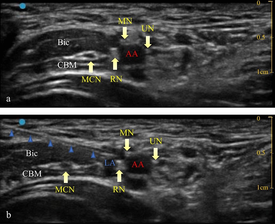 Minimum effective volume of 0.2% ropivacaine for ultrasound-guided axillary brachial  plexus block in preschool-age children | Scientific Reports