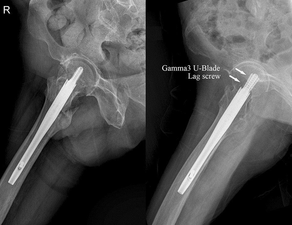 Additional use of anti-rotation U-blade (RC) decreases lag screw sliding  and limb length inequality in the treatment of intertrochanteric fractures  | Scientific Reports