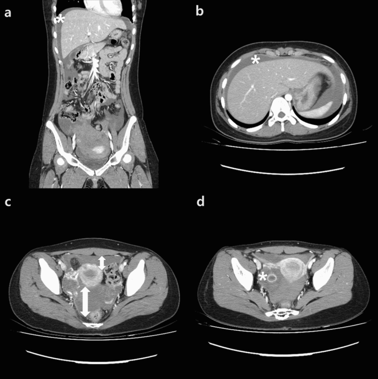 The predicting factors for indication of surgery in patients with  hemoperitoneum caused by corpus luteum cyst rupture