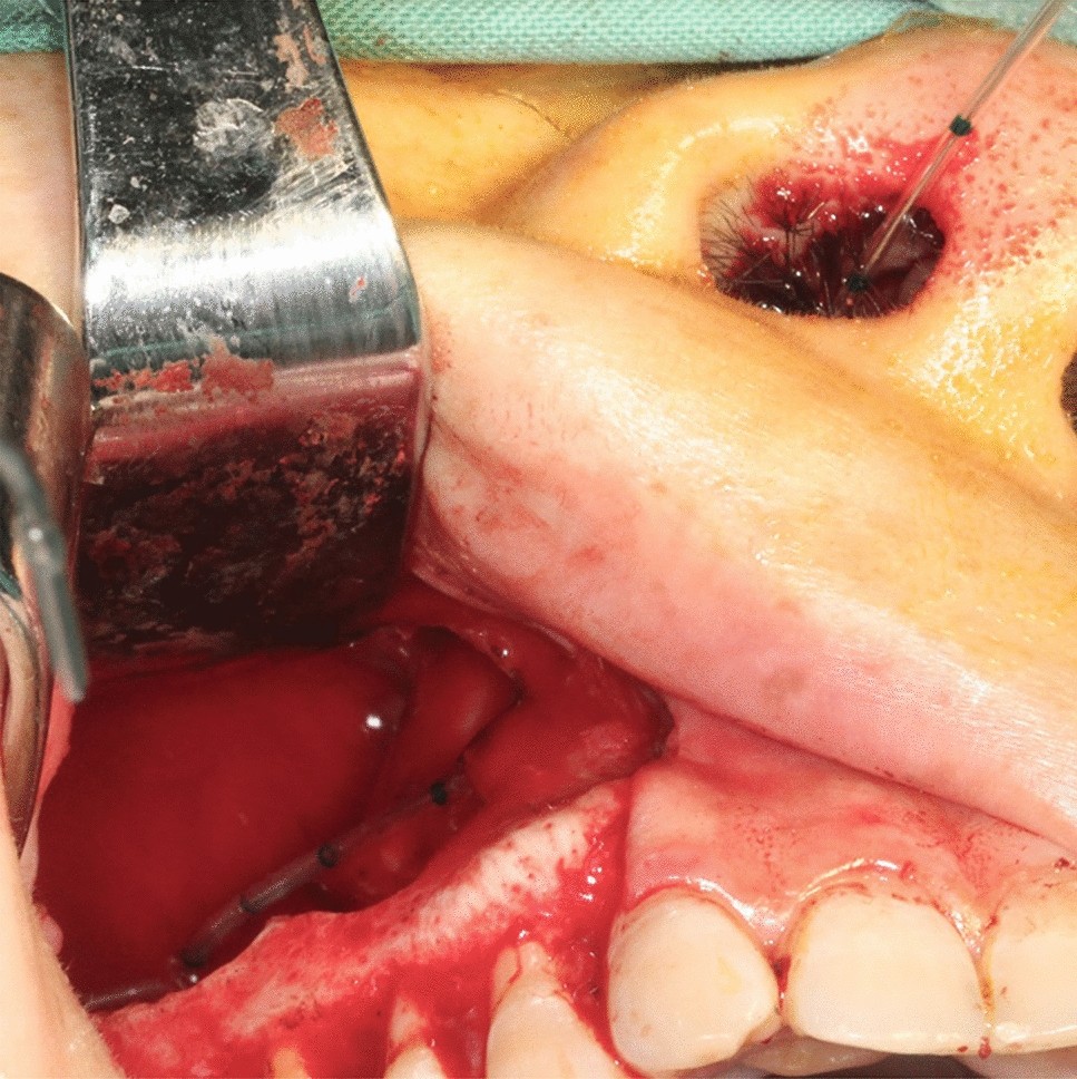 Comparing the efficacy of sinus irrigation with traditional Caldwell–Luc  procedure following odontogenic cyst surgery involving the maxillary sinus  | Scientific Reports