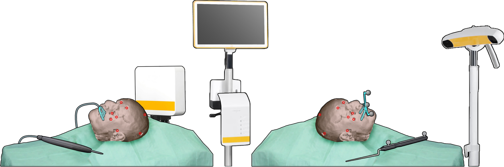 Registration-free workflow for electromagnetic and optical navigation in  orbital and craniofacial surgery | Scientific Reports