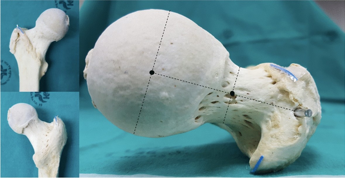 The radiographic relationship between the cortical overlap view (COV) and the tip of the greater trochanter | Scientific Reports The radiographic relationship between the cortical overlap view (COV) and the tip of the greater trochanter | Scientific Reports