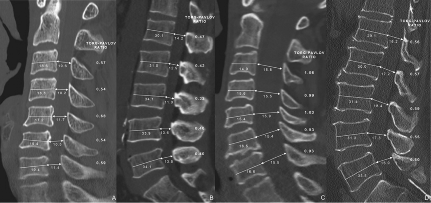 Spinal Anatomy Including Transverse Process and Lamina