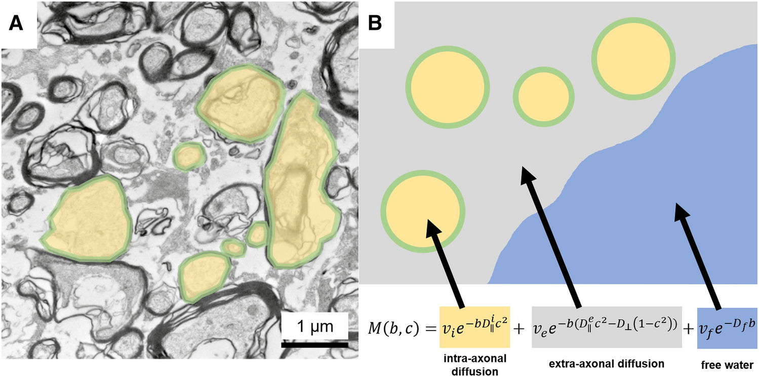 Increased interstitial fluid in periventricular and deep white matter  hyperintensities in patients with suspected idiopathic normal pressure  hydrocephalus | Scientific Reports