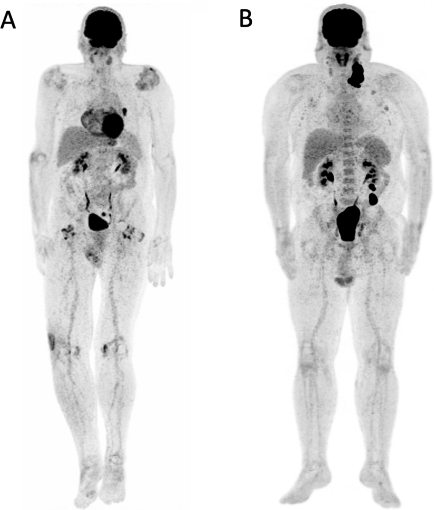 Fdg Pet Biomarkers For Prediction Of Survival In Metastatic Melanoma Prior To Anti Pd1 Immunotherapy Scientific Reports