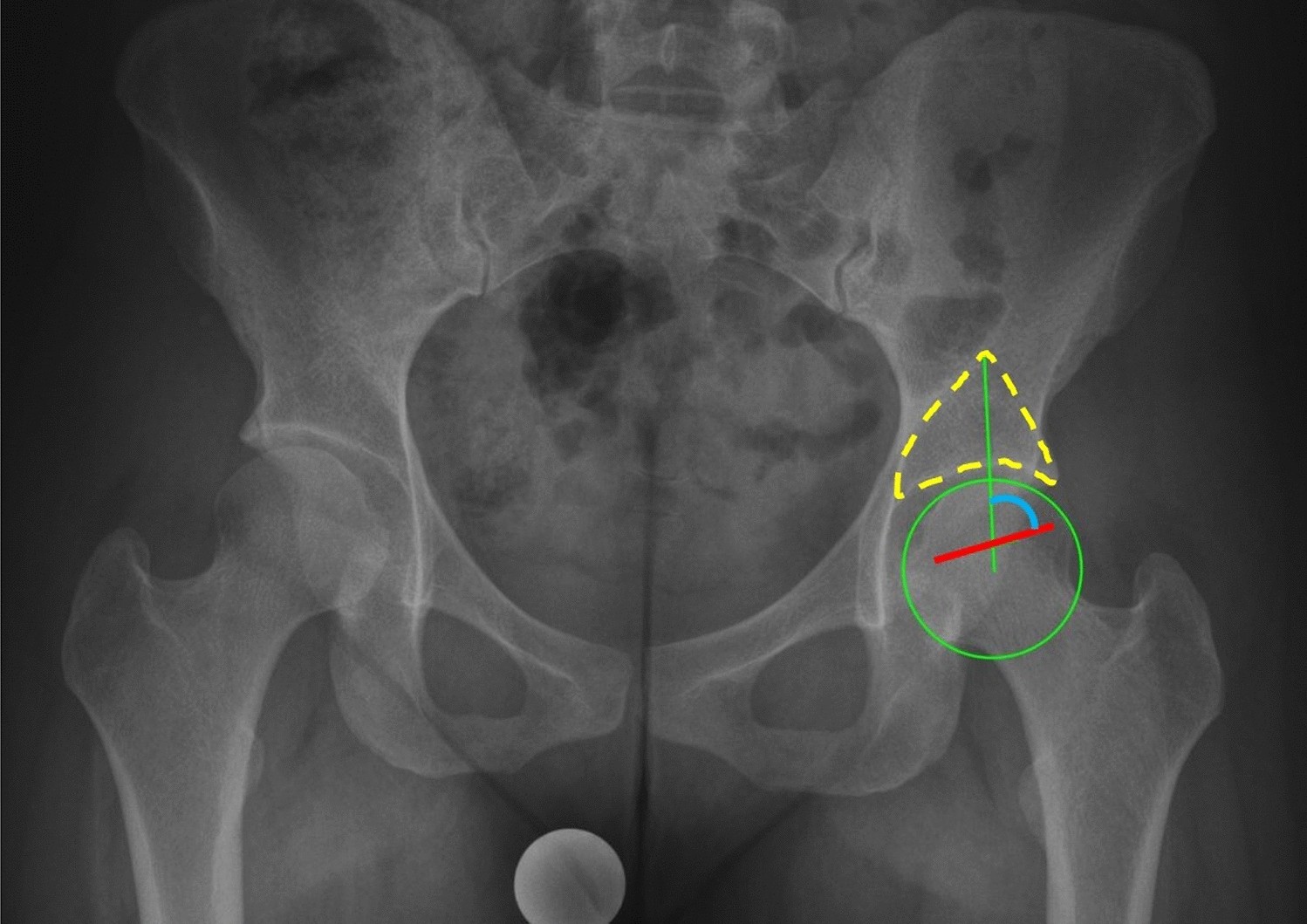Defining the Gothic Arch Angle (GAA) as a radiographic diagnostic tool for  instability in hip dysplasia | Scientific Reports