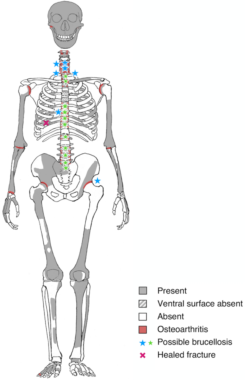 Possible vertebral brucellosis infection in a Neanderthal