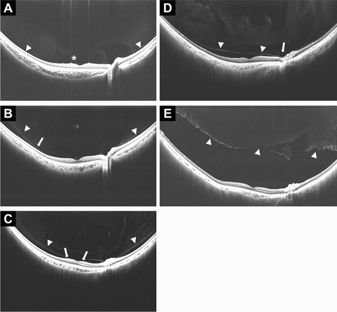 Widefield OCT scans showing stages of posterior vitreous detachment