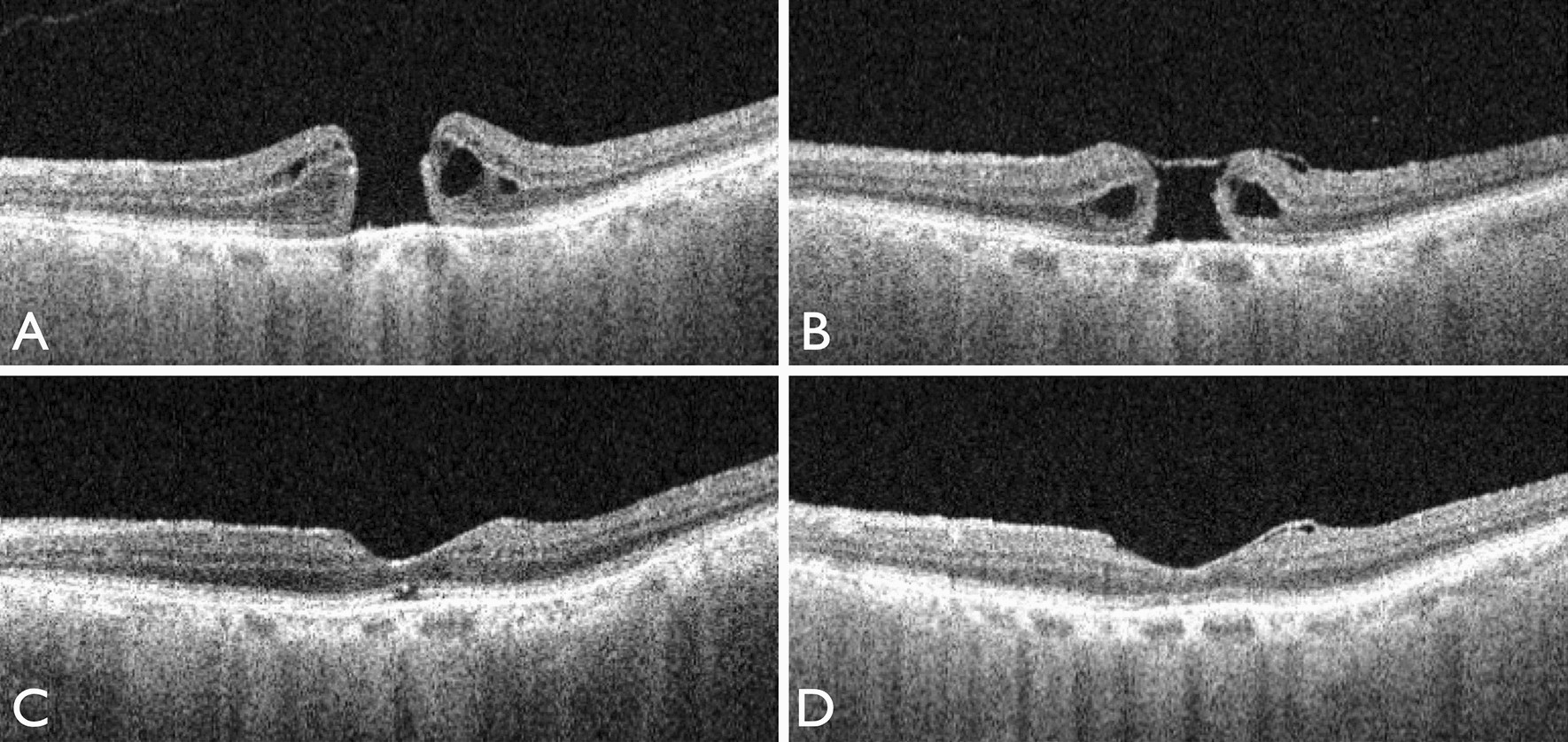contractility of temporal inverted internal limiting membrane flap after vitrectomy for macular hole scientific reports contractility of temporal inverted internal limiting membrane flap after vitrectomy for macular hole scientific reports