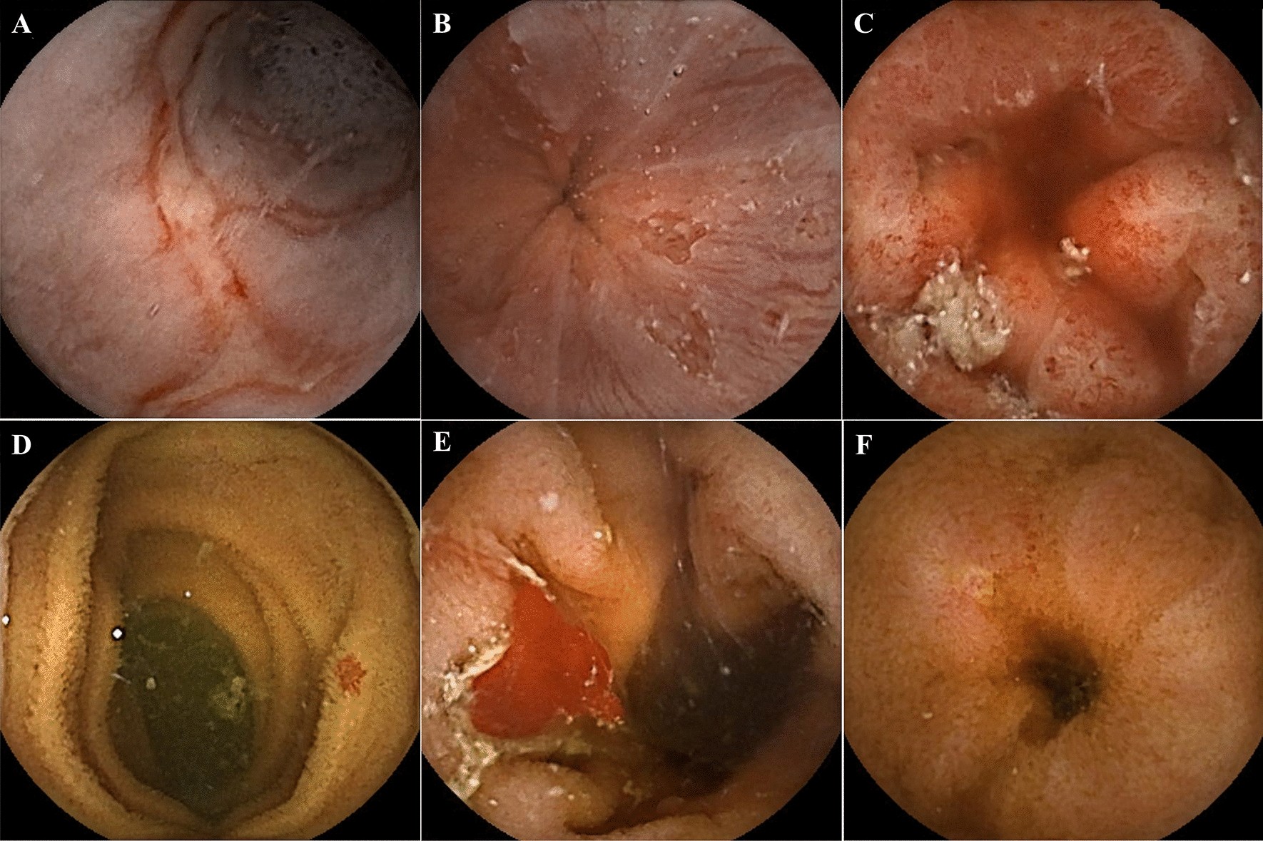 Best Small Bowel Capsule Endoscopy Doctor Upper East Side, NYC