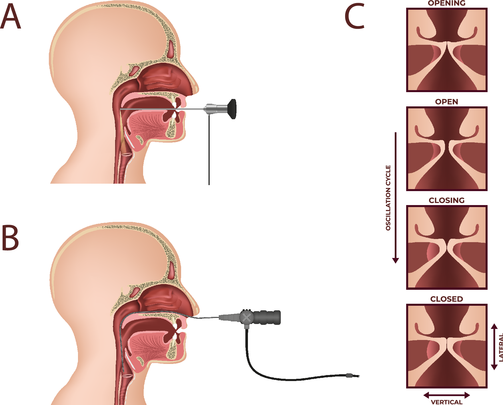 Comparative analysis of high-speed videolaryngoscopy images and sound data  simultaneously acquired from rigid and flexible laryngoscope: a pilot study  | Scientific Reports