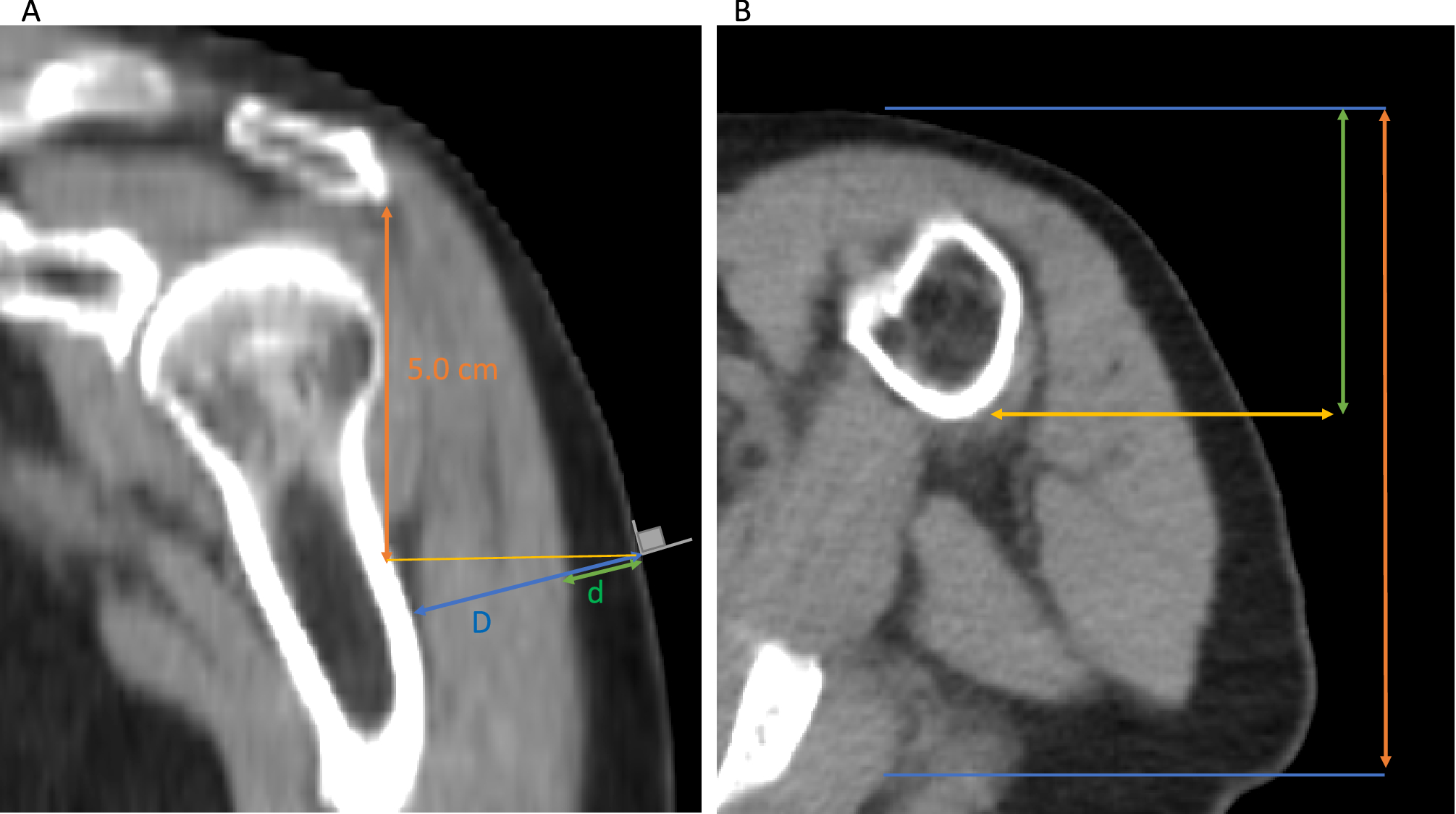 Statistical estimation of deltoid subcutaneous fat pad thickness:  implications for needle length for vaccination | Scientific Reports