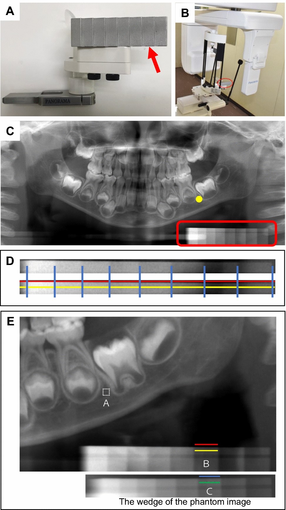 Evaluation of alveolar bone hypomineralization in pediatric  hypophosphatasia using orthopantomography | Scientific Reports