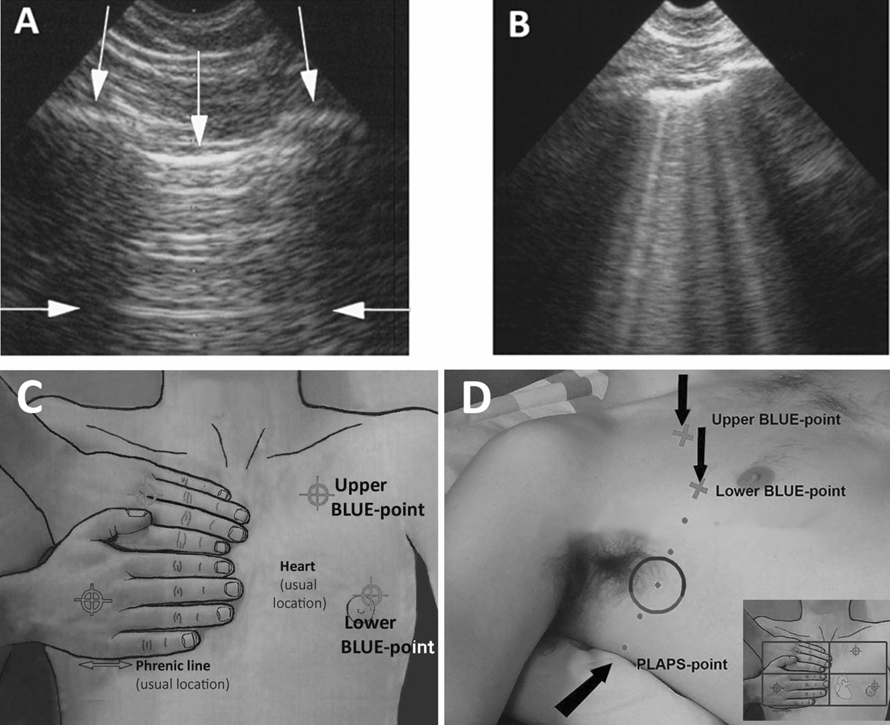 Assessment of fluid unresponsiveness guided by lung ultrasound in abdominal  surgery: a prospective cohort study | Scientific Reports