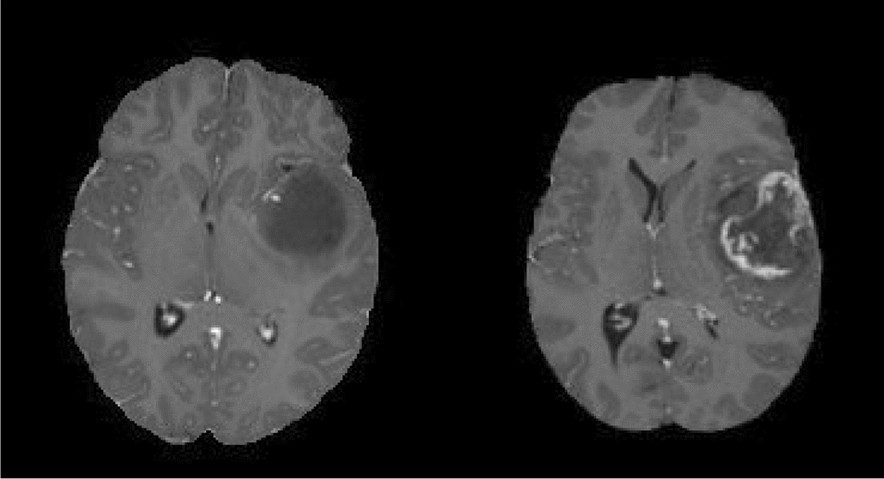 Krudt Hvad er der galt Lab Classification of brain tumours in MR images using deep spatiospatial  models | Scientific Reports