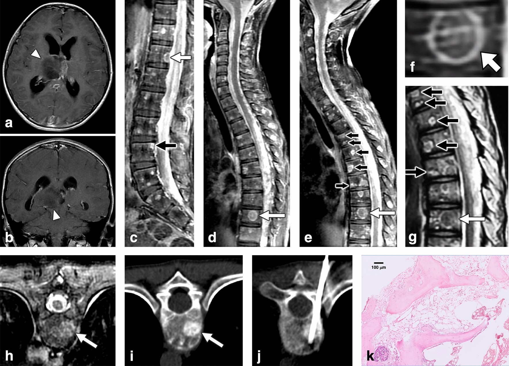 PDF) A rare cause of temporal lobe ring-enhancing lesion | sahil mehta -  Academia.edu