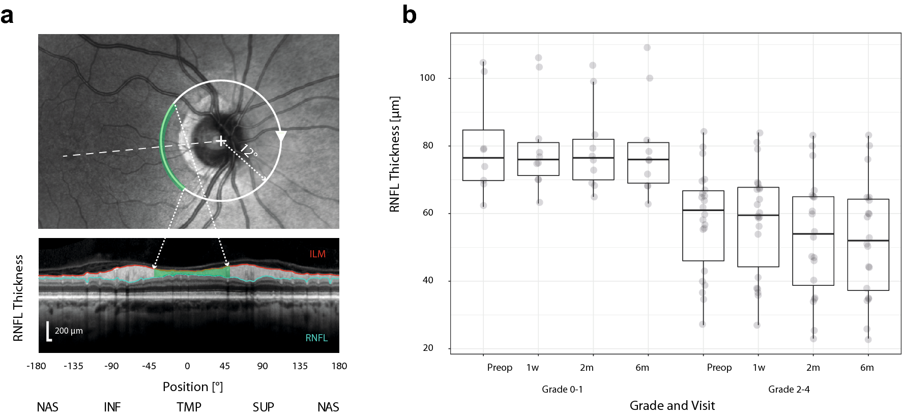 Optical coherence tomography and visual evoked potentials in evaluation of  optic chiasm decompression | Scientific Reports