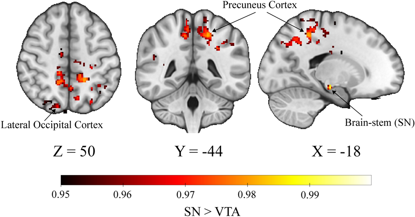 Distinct alterations in cerebellar connectivity with substantia nigra and  ventral tegmental area in Parkinson's disease | Scientific Reports
