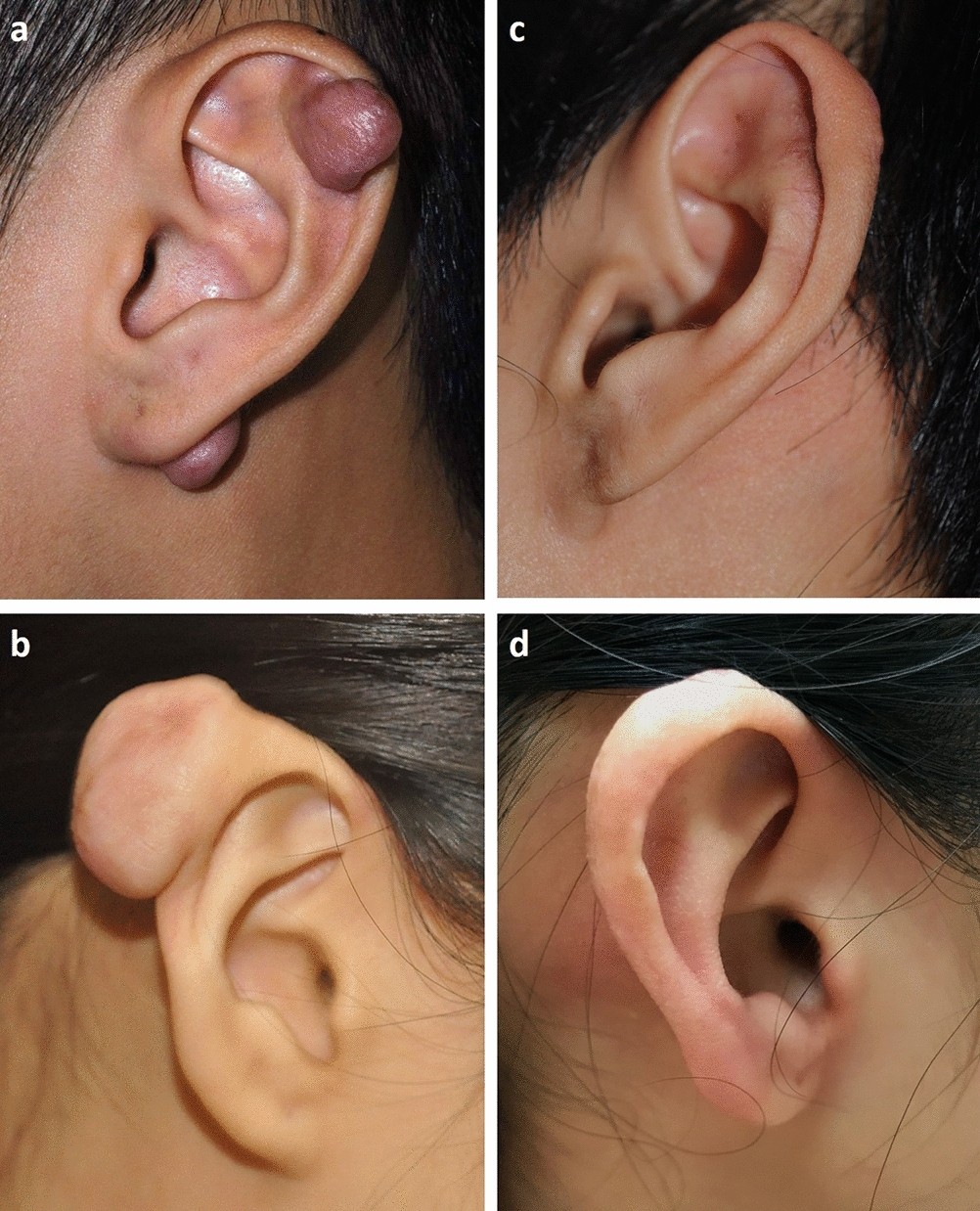 Giant relapsing earlobe keloid – Successful combined treatment by