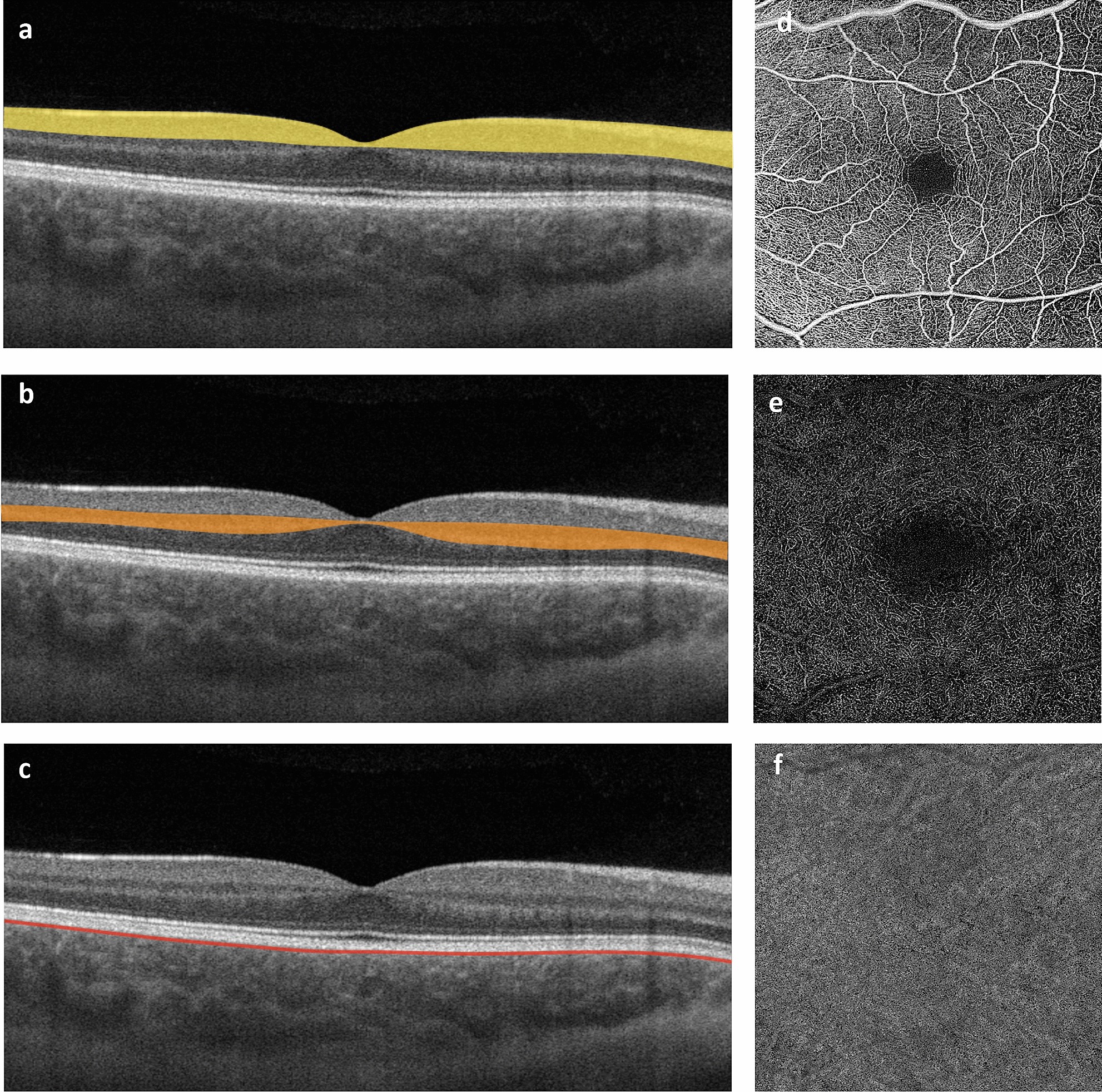 Changes Of The Retinal And Choroidal Vasculature In Cerebral Small Vessel Disease Scientific Reports Changes Of The Retinal And Choroidal Vasculature In Cerebral Small Vessel Disease Scientific Reports