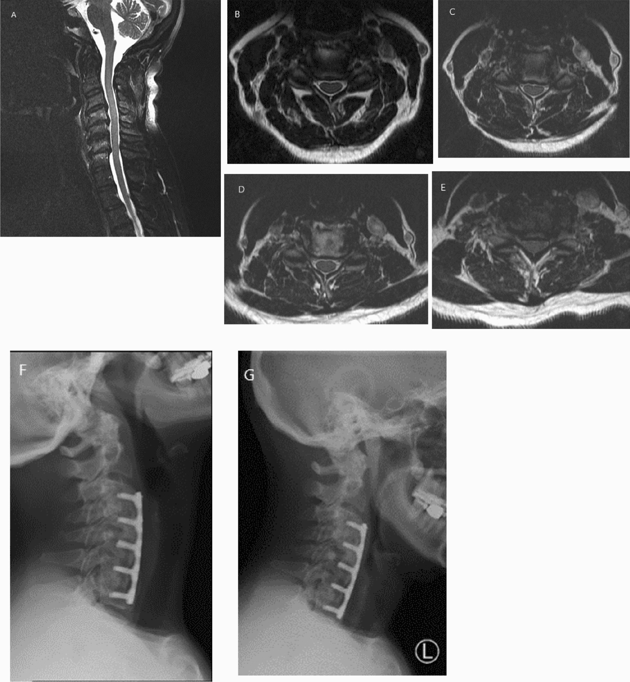 C3-4 and C4-5 discectomy