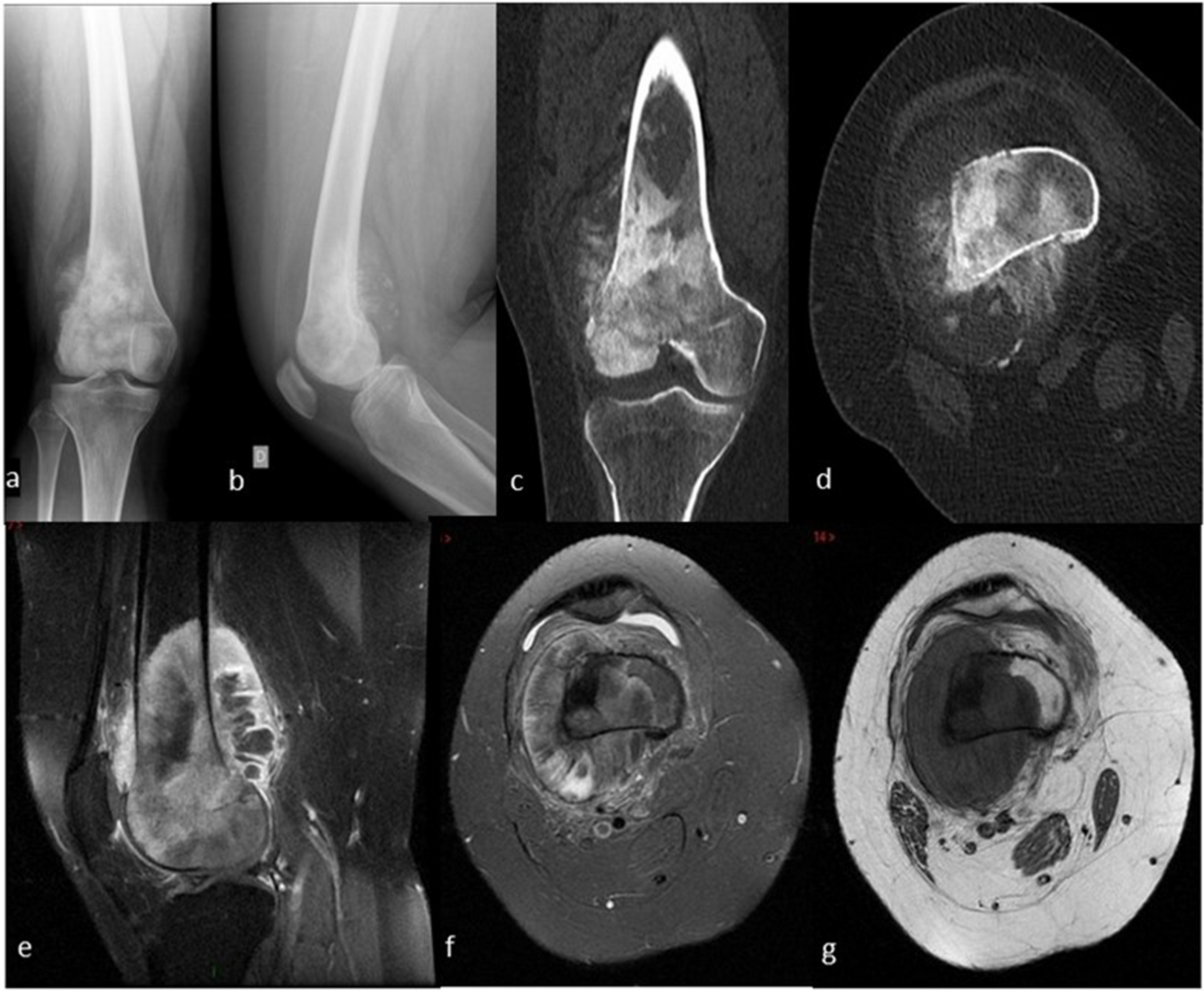 Corrupt grijs jongen The appropriate and sequential value of standard radiograph, computed  tomography and magnetic resonance imaging to characterize a bone tumor |  Scientific Reports