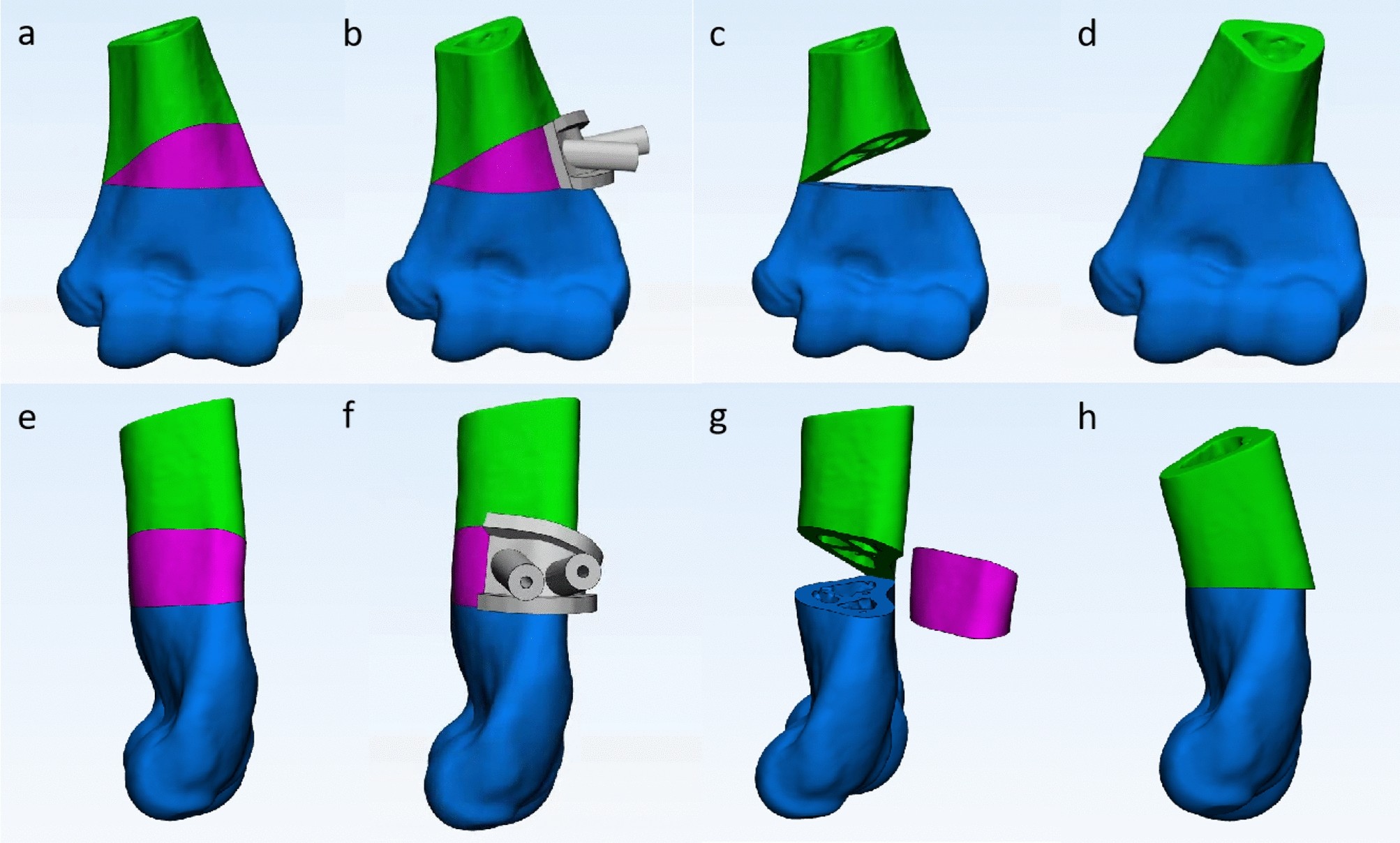 Revista Brasileira de Ortopedia - Treatment of Distal Radio Vicious  Consolidation: Corrective Osteotomy Through 3D Printing  Prototyping<sup>*</sup>