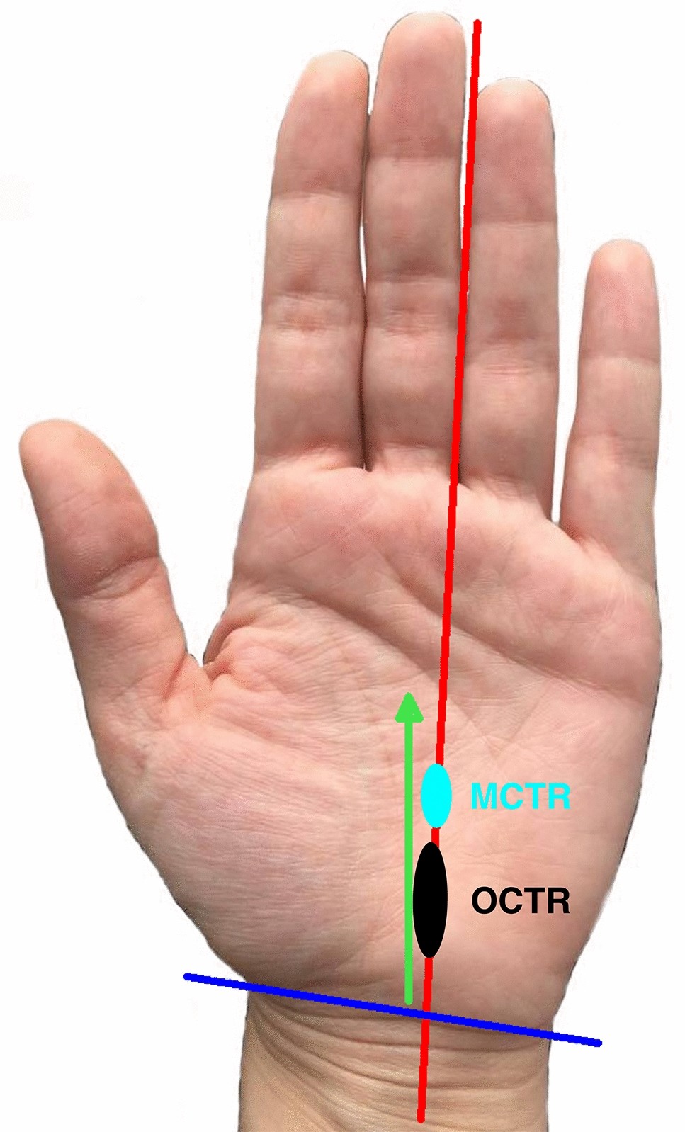 Mini-open carpal tunnel release: technique, feasibility and clinical  outcome compared to the conventional procedure in a long-term follow-up
