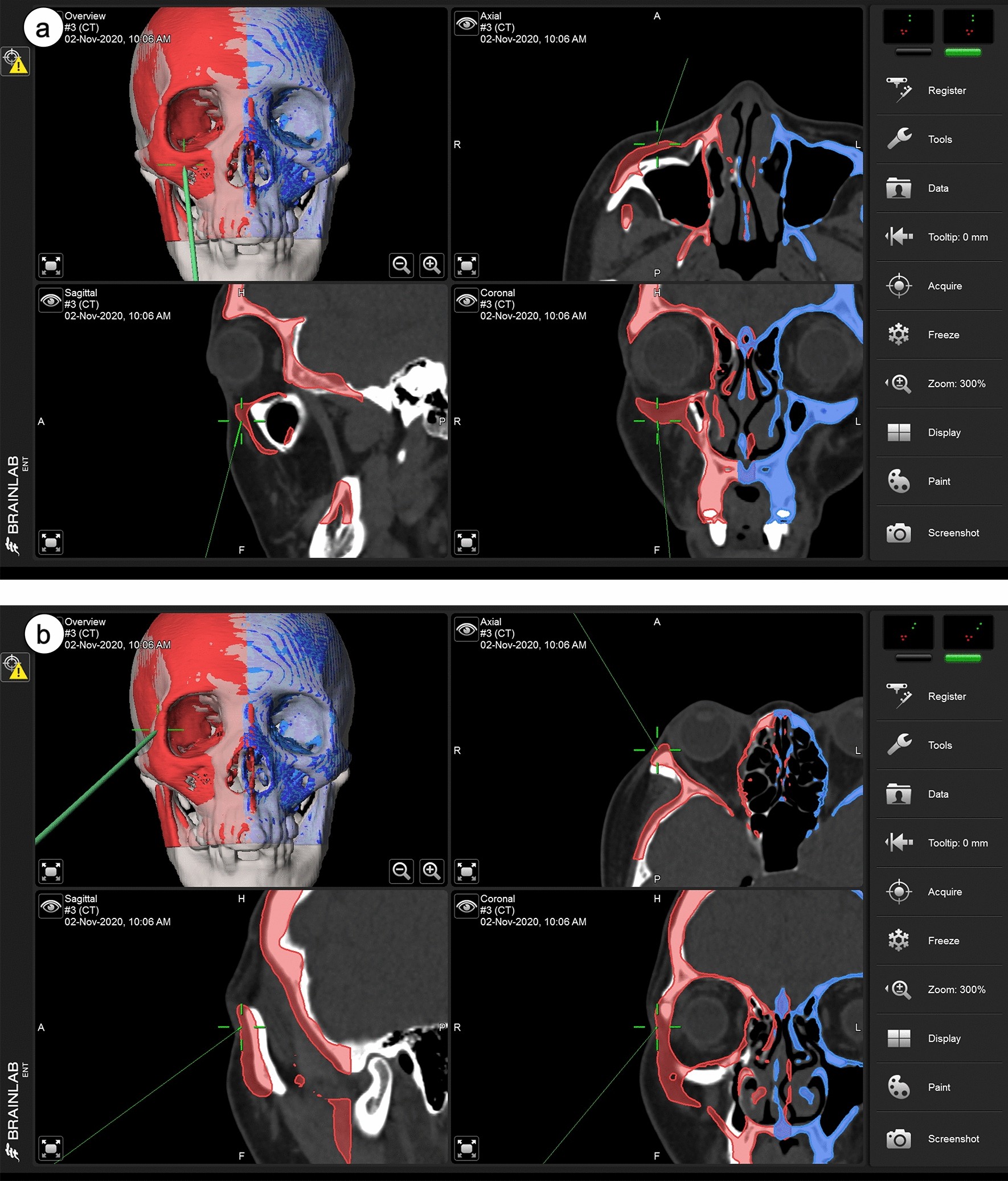 Preliminary outcomes of the surgical navigation system combined with intraoperative three-dimensional C-arm computed tomography for zygomatico-orbital fracture reconstruction | Scientific Reports