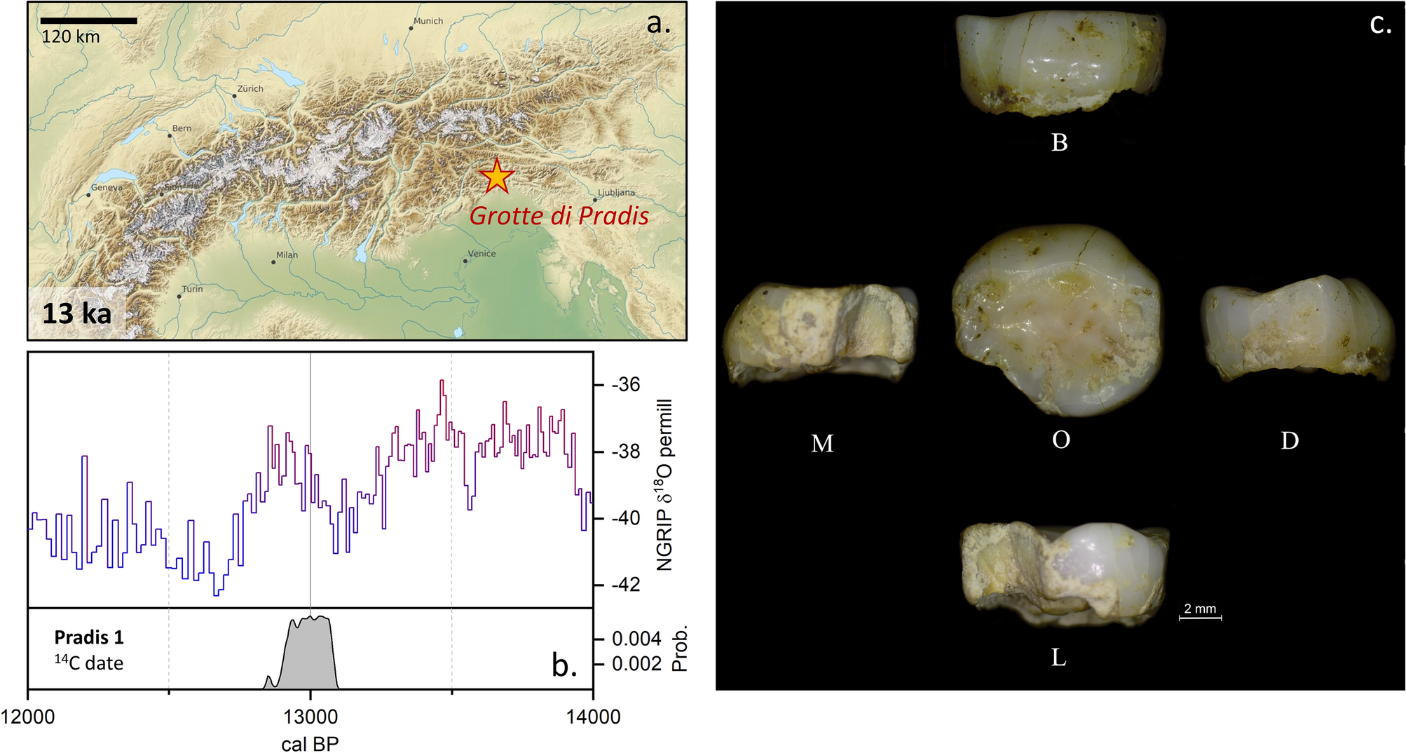 a) Depicting visible fracture lines within the enamel suggestive of