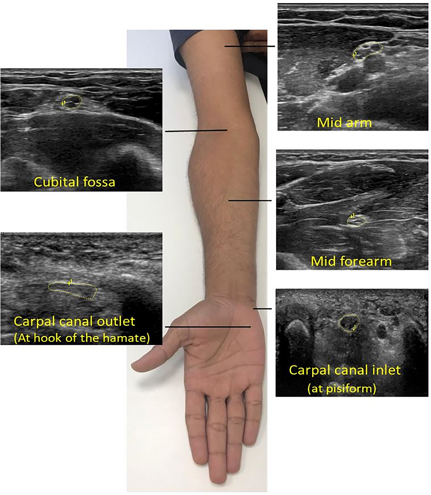 A systematic review: normative reference values of the median nerve  cross-sectional area using ultrasonography in healthy individuals