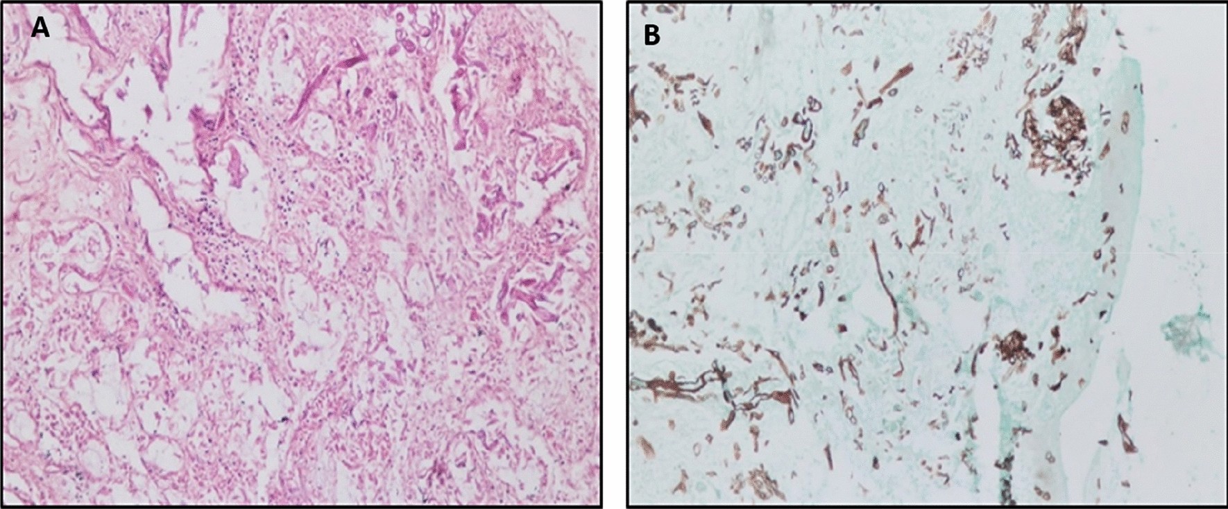 COVID-19 associated mucormycosis in Assiut University Hospitals: a  multidisciplinary dilemma | Scientific Reports