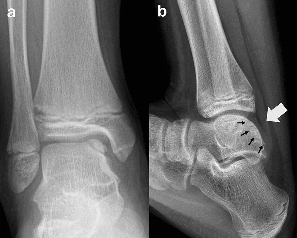 Foot X-ray of a 10 year-old male patient (white arrow indicates