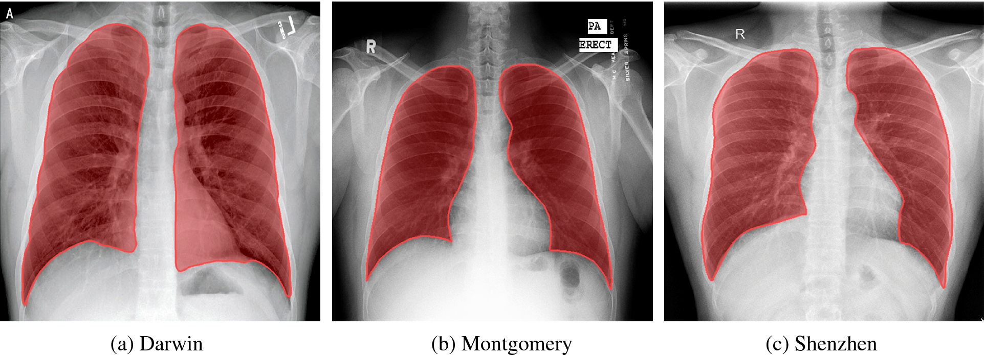 Automatic scoring of COVID-19 severity in X-ray imaging based on a novel  deep learning workflow | Scientific Reports