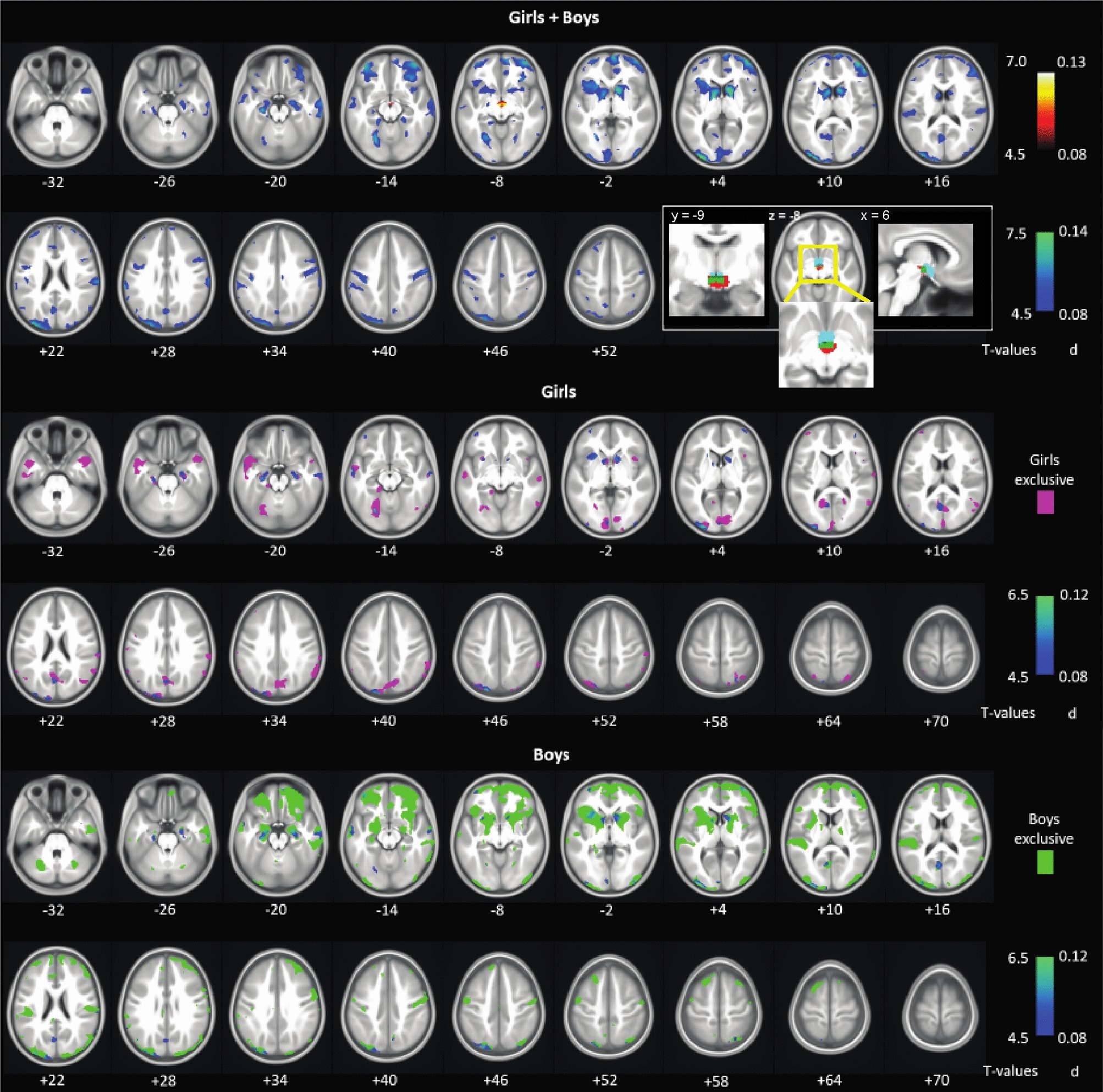 Gray matter volumetric correlates of attention deficit and hyperactivity  traits in emerging adolescents | Scientific Reports