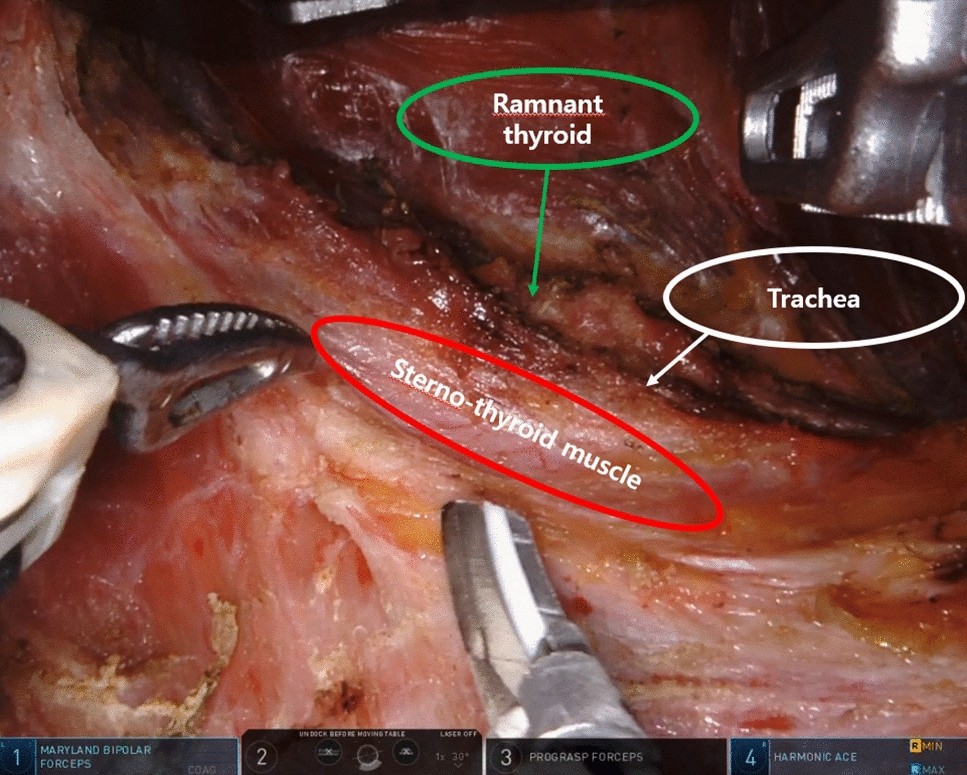 Re-do Operation Using a Robotic System due to Locoregional Recurrence after  Initial Thyroidectomy for Thyroid Cancer | Scientific Reports