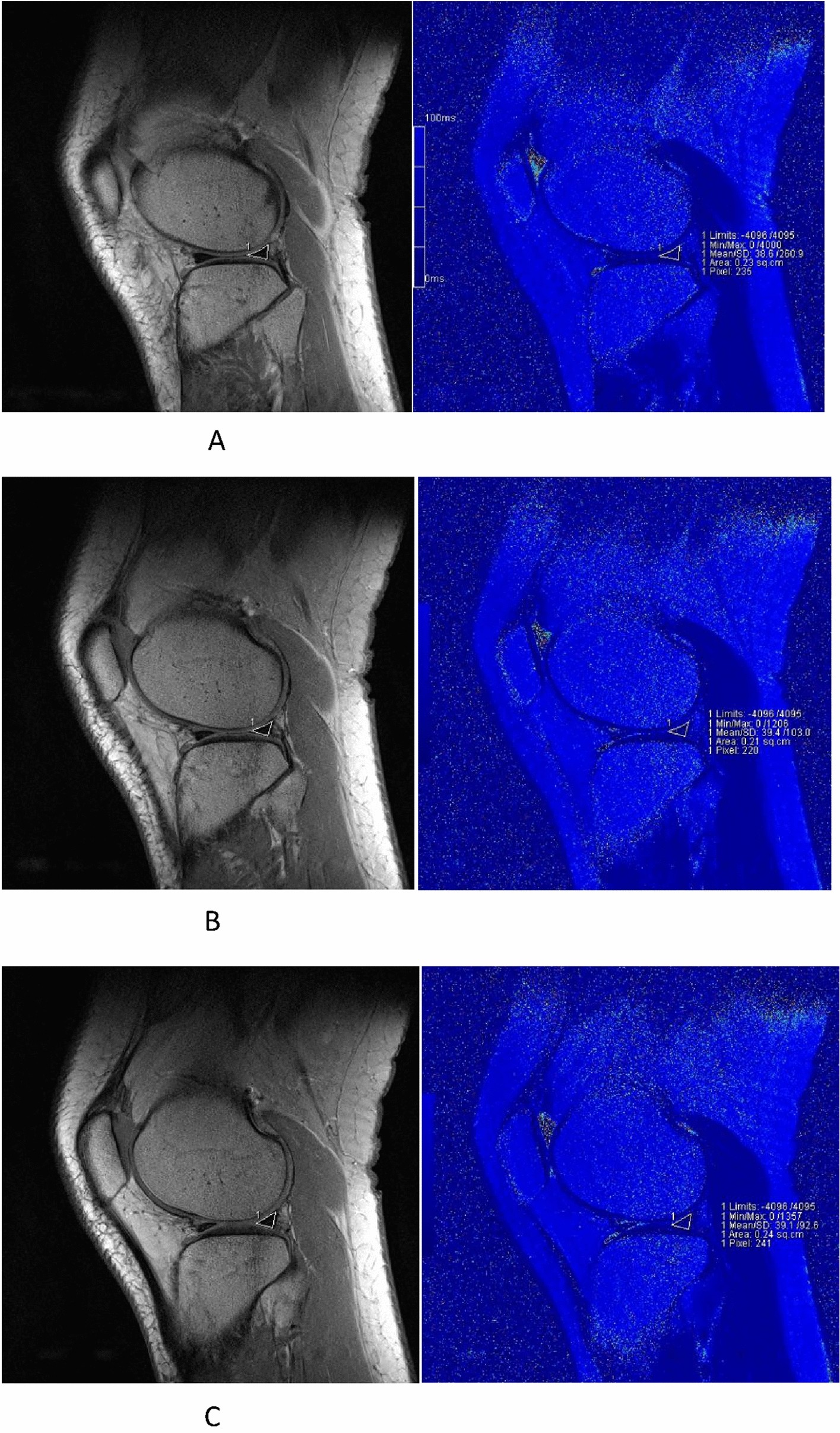 Periodical assessment of four horns of knee meniscus using MR T2 mapping imaging in volunteers before and after amateur marathons Scientific Reports