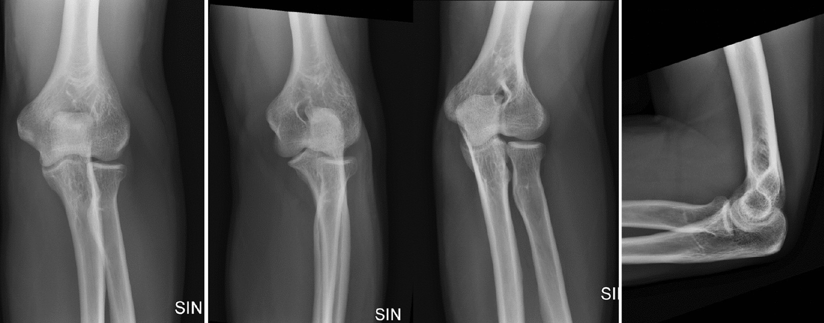 Deep learning accurately classifies elbow joint effusion in adult and  pediatric radiographs | Scientific Reports