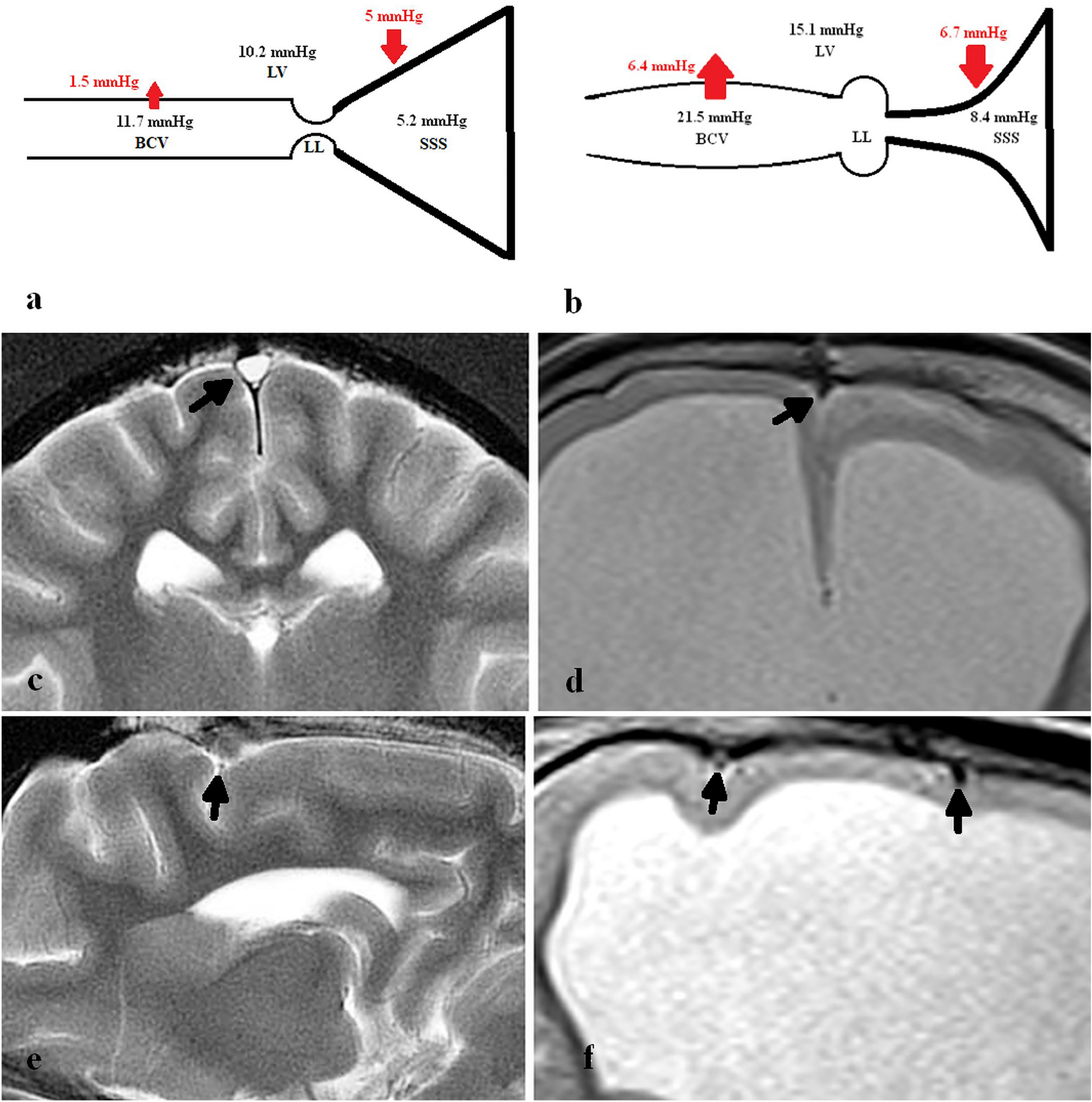 Dilatation of the bridging cerebral cortical veins in childhood  hydrocephalus suggests a malfunction of venous impedance pumping |  Scientific Reports