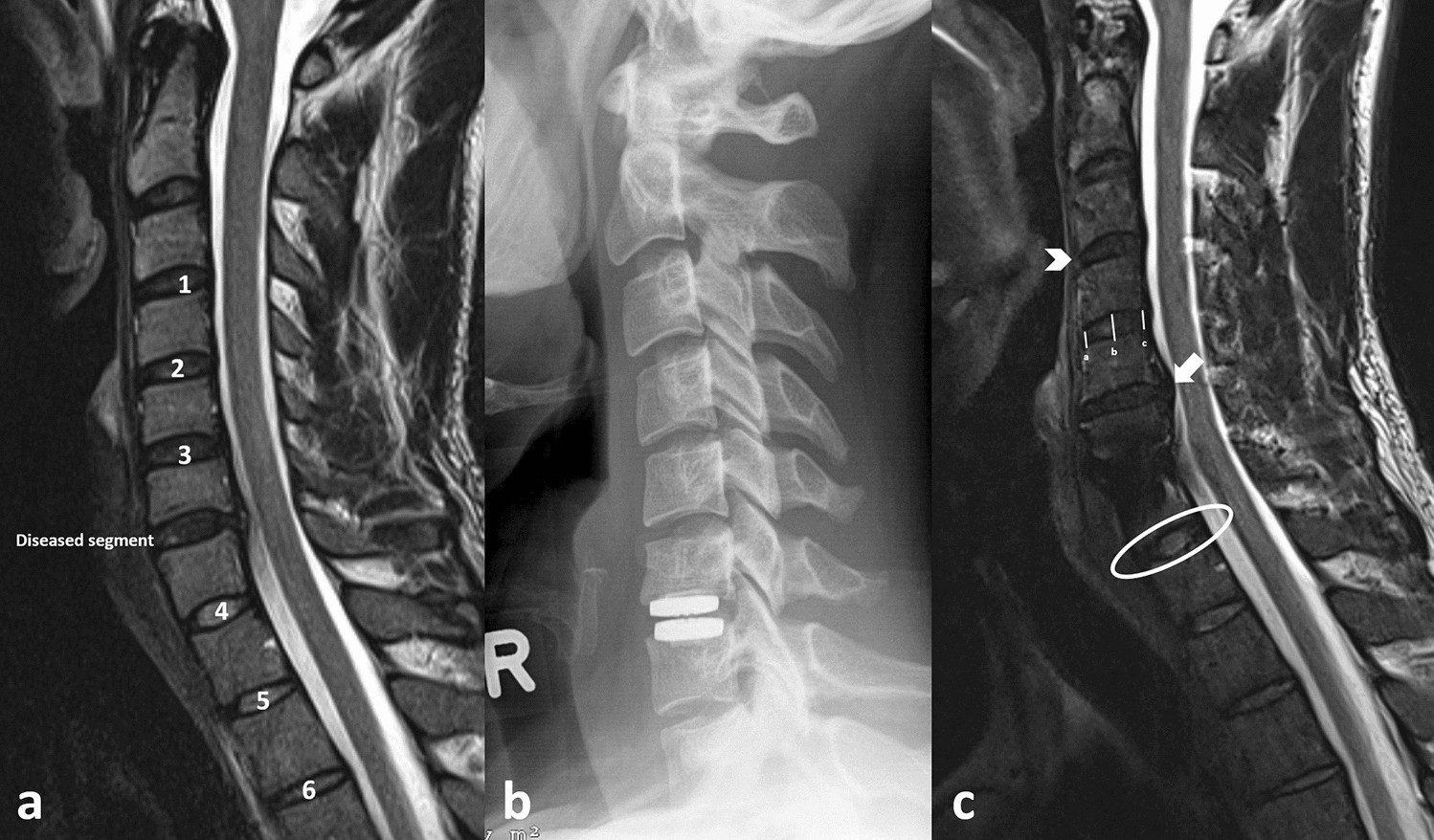 cervical disc replacement procedure