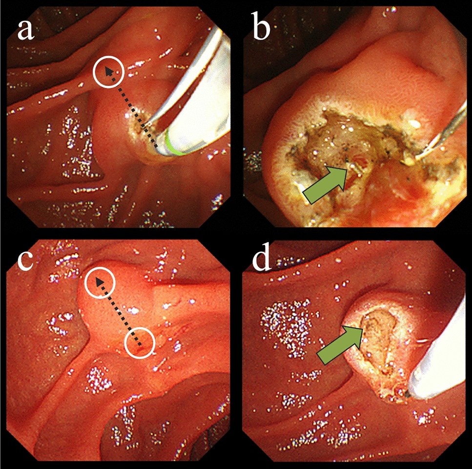 Preputioplasty as a surgical alternative in treatment of phimosis